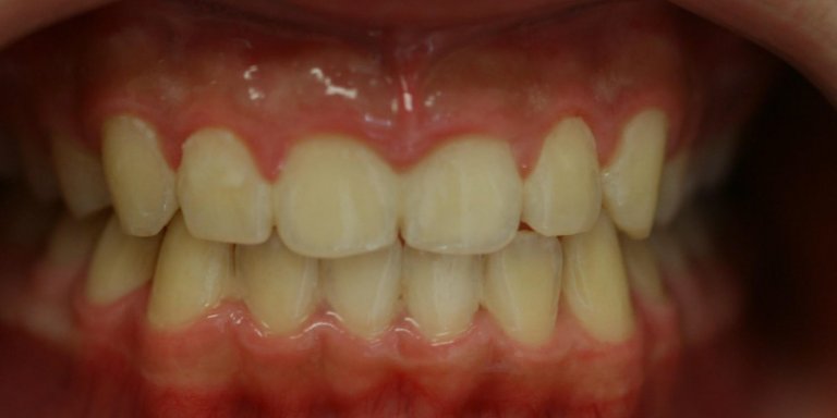 Braces — Bite Correction — after treatment