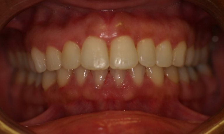 Braces — Alignment & Spacing — after treatment