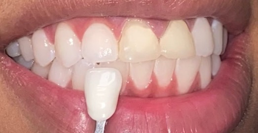 Dental Crowns — Front Tooth Restoration — before treatment