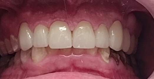 Dental Crowns — Smile Restoration — after treatment