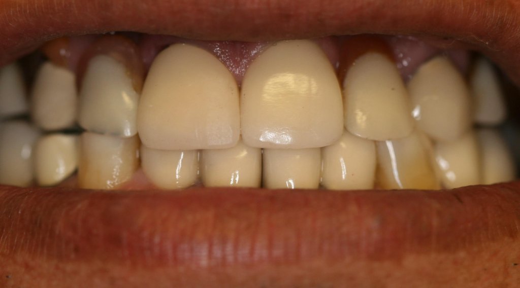 Dental Crowns — Worn Teeth Rebuilt — after treatment