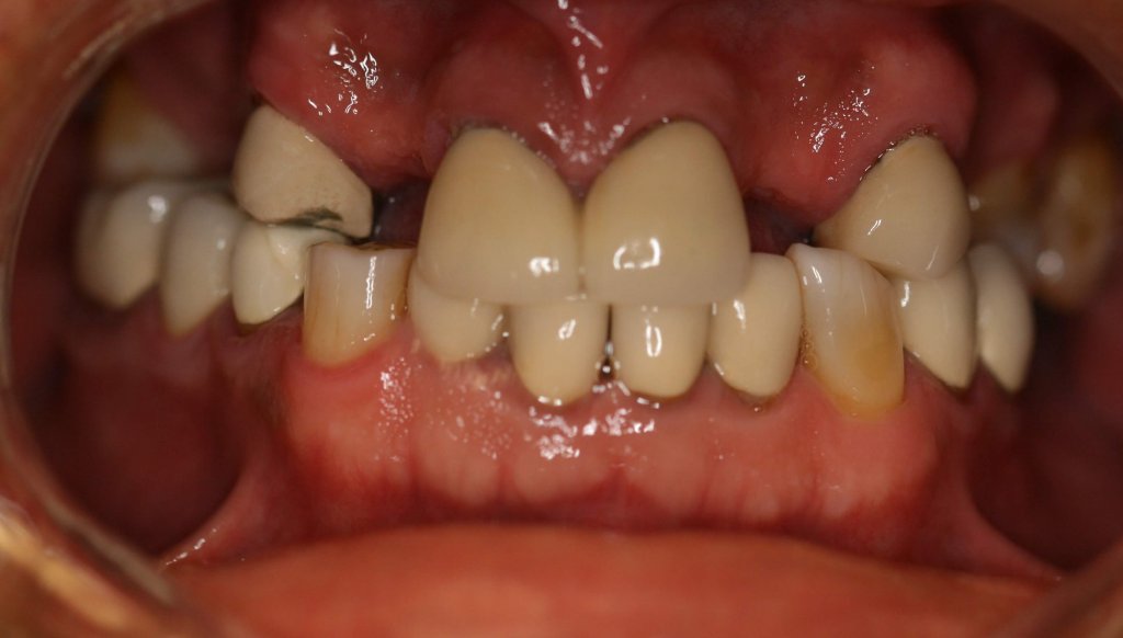 Dental Crowns — Worn Teeth Rebuilt — before treatment