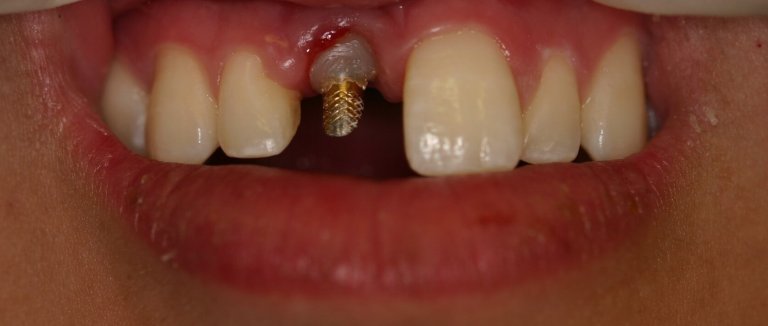 Dental Implants — Missing Tooth Replacement — before treatment