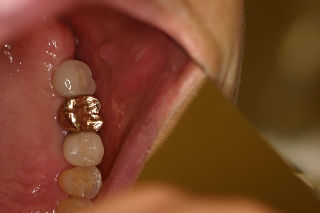 Dental Implants — Natural-Looking Restoration — after treatment