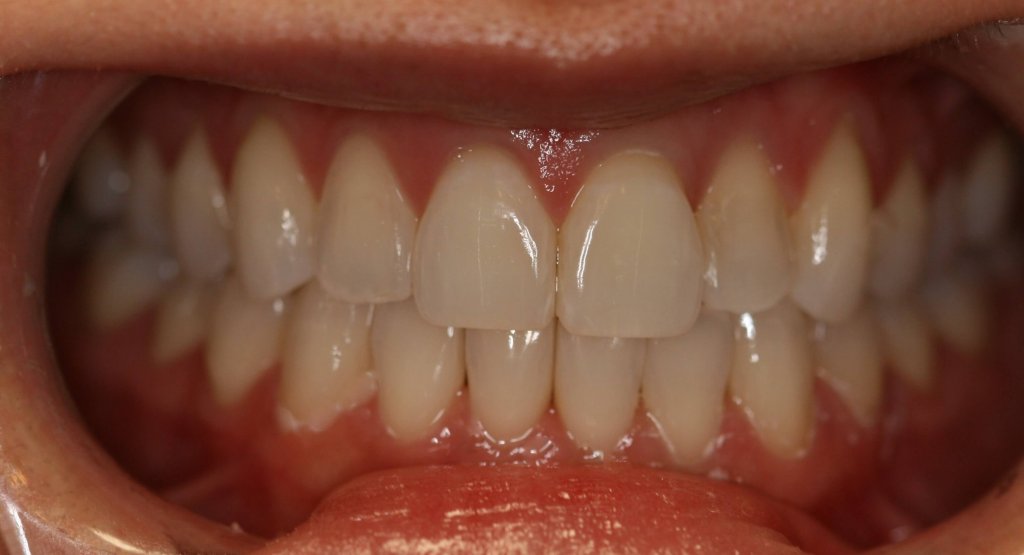 Invisalign — Discreet Alignment — after treatment