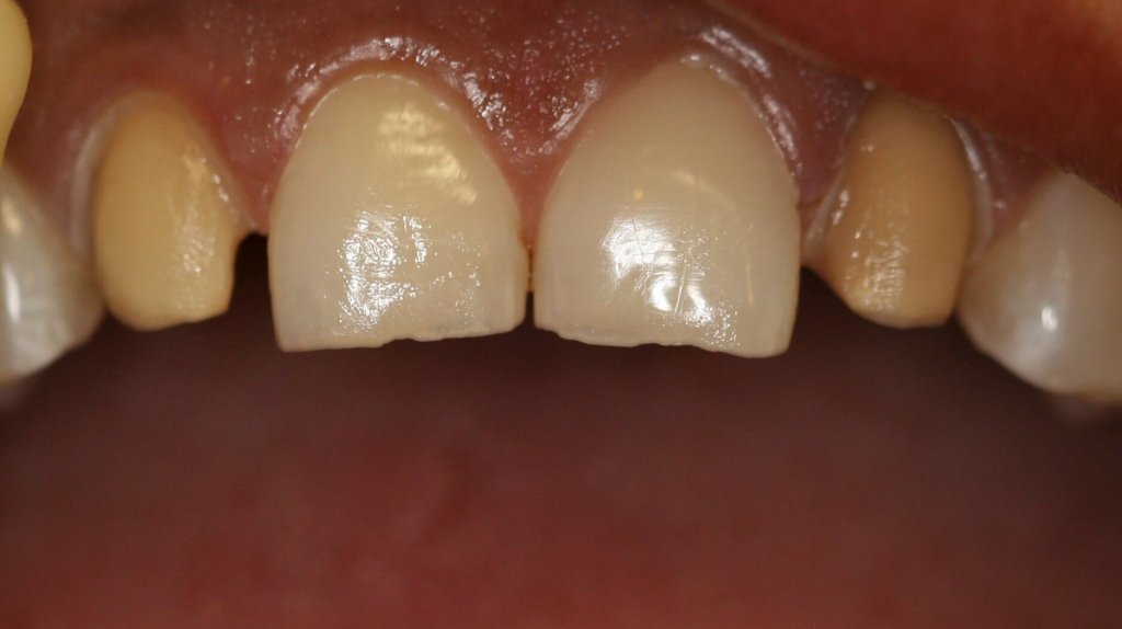 Porcelain Veneers — Final Result