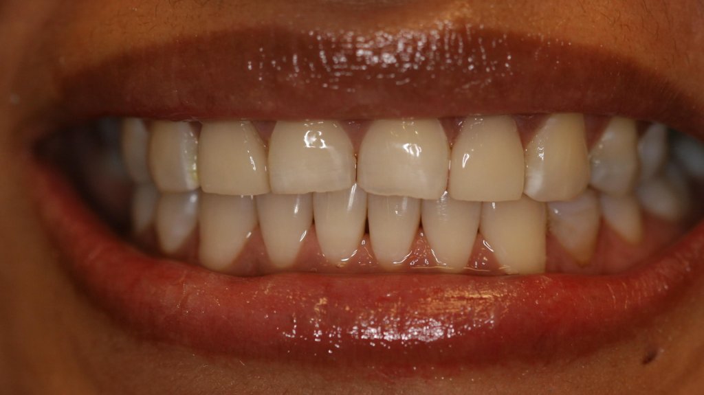 Porcelain Veneers — Smile Transformation