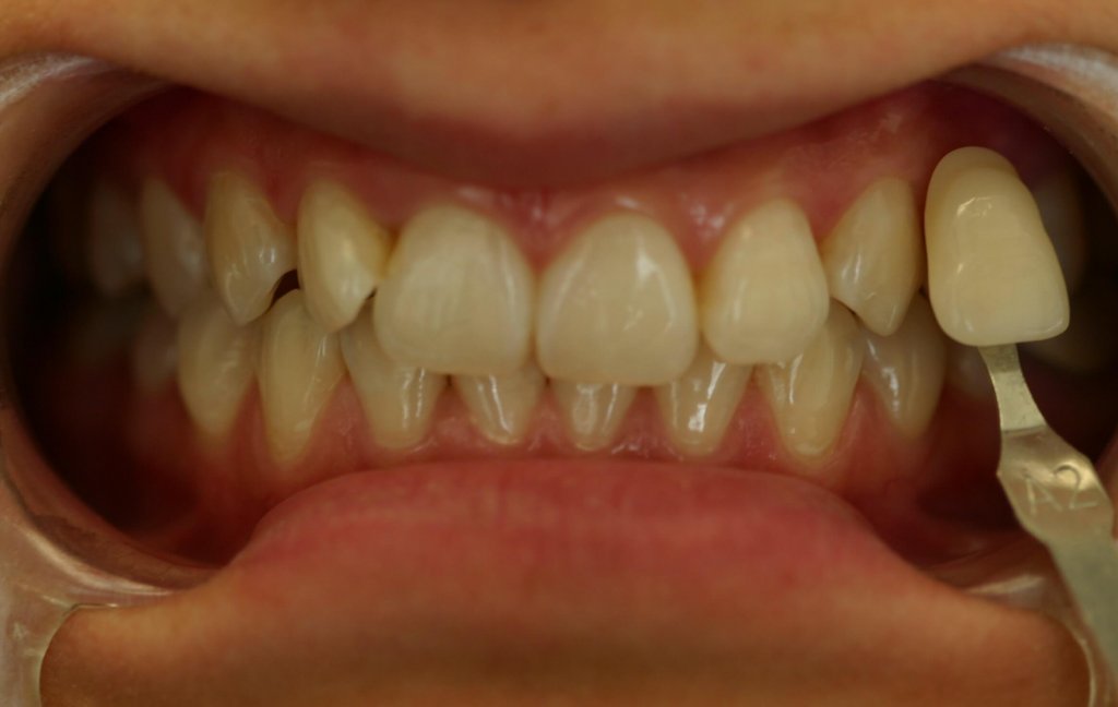 Zoom Whitening — Brighter Smile — before treatment