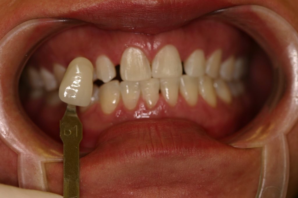 Zoom Whitening — Stain Removal — after treatment